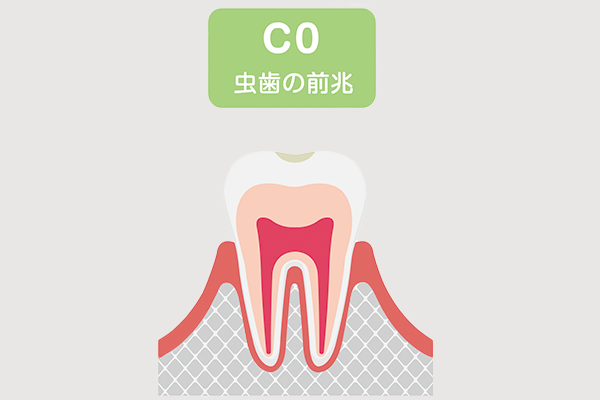 虫歯の症状「CO」