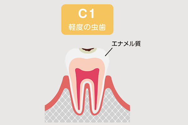 虫歯の症状「C1」