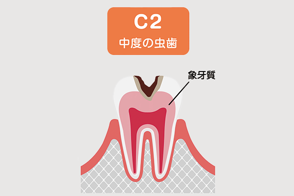 虫歯の症状「C2」