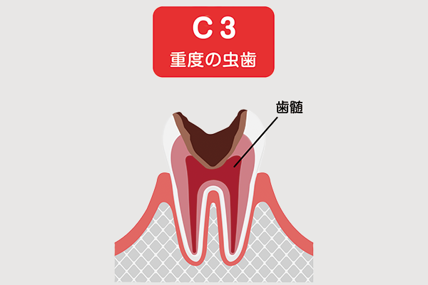 虫歯の症状「C3」