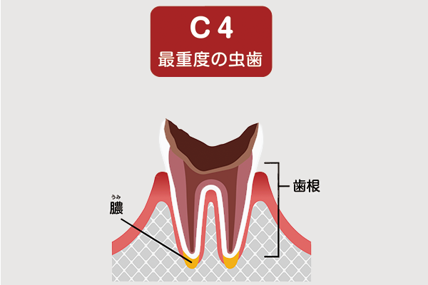 虫歯の症状「C4」